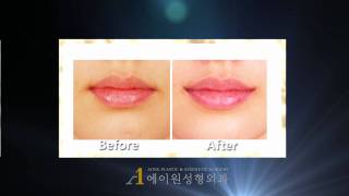 KOREA Mouth corner lift before amp after plastic surgery [upl. by Aicened]