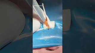 Root canal treatment amp composite restoration dentist [upl. by Ilsa]