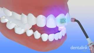 Colocación de brackets  PROCESO de cementación paso a paso 3D [upl. by Eardna882]