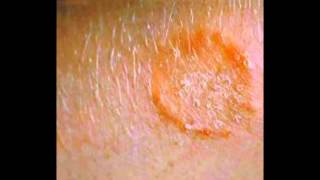 Skin Fungus Signs Symptoms Treatment HD [upl. by Consuela]