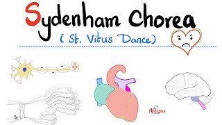 Sydenham Chorea St Vitus Dance  Rheumatic Fever  Neurology amp Cardiology [upl. by Dnomrej842]