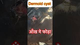 Dermoid cyst l Eye injection l dr Umar Khan [upl. by Letney]