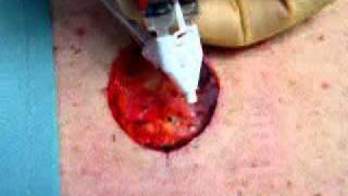 Fibrin Spray to Aid in Wound Healing [upl. by Sidman]