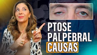 Entendendo as Causas da Ptose Palpebral [upl. by Elleivap]