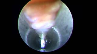 Endoscopic Decompression Of Interdigital Neuroma  MYFOOTSHOPCOM [upl. by Mutat]