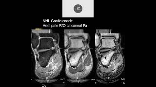 MRI of the Ankle Part 12 – Ankle Impingement [upl. by Nerro355]