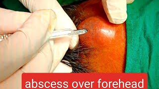 abscess over forehead  infected cyst over forehead  incision n drainage youtube dr doctor [upl. by Eetsirhc]