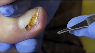 Ingrown Toenail Removal  Pedicure Treatment and Very Satisfying  Best Satisfying Nail Cutting [upl. by Lacee]