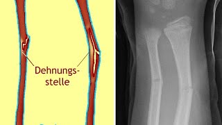 Grünholzfraktur Ursachen Diagnose und Behandlung [upl. by Gaughan360]