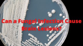 Can A Fungal Infection Cause Brain Lesions [upl. by Antonina]