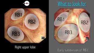 Mastering Bronchoscopy for Thoracic Surgery Chapter 2 [upl. by Elo]