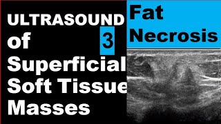 Fat Necrosis Ultrasound [upl. by Maclean]