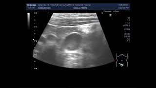 Mesenteric lymphadenitis [upl. by Neelcaj]