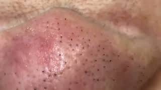 how to get rid of comedones treatment and remove blackheads [upl. by Noble]