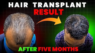 Hair Transplant 5 month review Hair Transplant in jharkhand hairtransplantcostinindia haircut [upl. by Mundford955]