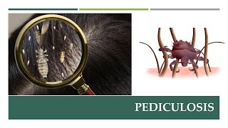 Lice Infestation Pediculosis Lecture [upl. by Norraa]