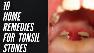 10 Home Remedies For Tonsil Stones That Work Fast  How To Get Rid of Tonsil Stones at Home [upl. by Einobe]