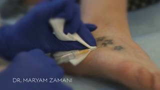 Plexr for Tattoo Removal  Dr Maryam Zamani [upl. by Rosalee]