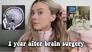 1 year after brain surgery  my brain cancer journey [upl. by Buckler]