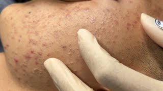 Blackheads amp Whiteheads Removal New 2024  Acne Treatment With Bo Nguyễn Spa 007 [upl. by Abbub840]