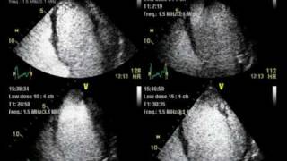 CONTRAST ECHO LV non COMPACTION  ECHOCARDIOGRAPHY cardiac ultrasound [upl. by Bevin]