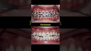 Braces Fix Misaligned Jaw braces orthodontist dentist bracesoff [upl. by Eiramik633]