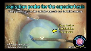 CataractCoach™ 2384 aspiration probe for the capsulorhexis [upl. by Llenet]