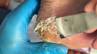 Very dry and cracked heel covered with thick callus【Joo Yidao】 [upl. by Azaleah474]