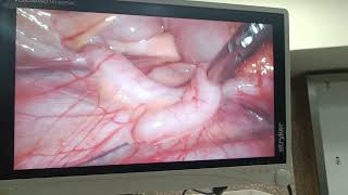 ureteric peristalsis during laparoscopic surgery [upl. by Ermey534]