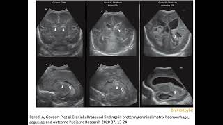 14 Intraventricular hemorrhage germinal matrix IVH caudothalamic premature NICU neuroimaging [upl. by Sessler]