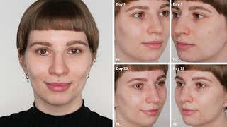 The Ordinary and Paulas Choice Azelaic Acid 10  4 Weeks Before and After Pictures  Split Face [upl. by Erdnaet]