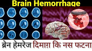 Brain hemorrhageICH Intracranial hemorrhagesymptomscausesManagement ब्रेन हेमरेज क्या होता है [upl. by Naresh440]