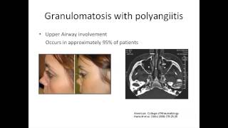 ANCA Vasculitis A Rheumatologists Perspective by Padmapriya Sivaraman MD [upl. by Otrebmuh]