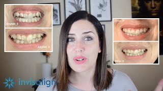 Mi Experiencia con INVISALIGN 😁↔ 20 semanas con ortodoncia invisible  Vlog 🎬 [upl. by Starobin]