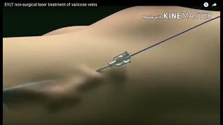 EVLT Laser Treatment for Varicose Veins The Future of Varicose Vein Treatment Animation Video [upl. by Cired]