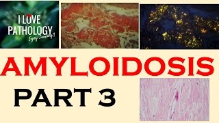 AMYLOIDOSIS PART 3 Morphology Diagnosis Special stains clinical features amp Prognosis [upl. by Marjorie]