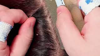 Silent ASMR Scalp Therapy Gentle Exfoliation amp Dandruff Removal No Talking [upl. by Yenreit310]