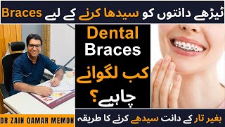 Dental Braces Everything You Should Know About  Types of Dental Braces  All About Braces [upl. by Jamey]