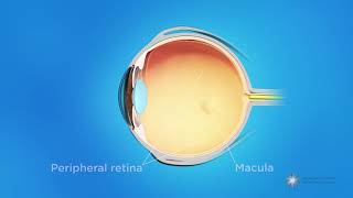 What is retinopathy of prematurity ROP [upl. by Brandice160]