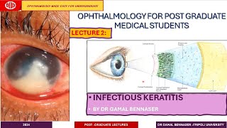 Infectious Keratitis STATE OF THE ART DIAGNOSIS AND MANAGMENT LECTURE 2 Bacterial KERATITIS [upl. by Aerdnu]