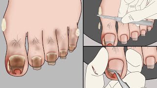 ASMR Ingrown Toenail Removal Treatment AnimationStrong Satisfaction  Mengs Stop Motion [upl. by Hillard]