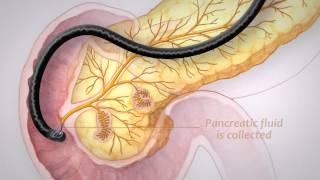 Pancreatic Cancer Screening [upl. by Ifen178]