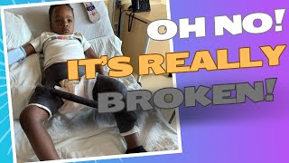 How Our toddler fractured his femur boneSpica Cast [upl. by Twila]