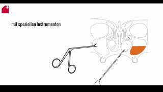 Nasennebenhöhlen OP  FESS  chronische Sinusitis [upl. by Terri]