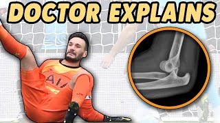 Doctors Guide to Hugo Lloris Elbow Dislocation [upl. by Helsie]