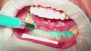 Video Procedures of Cosmetic Dentistry Treatment at Cosmetic Dental Associates [upl. by Wendel509]