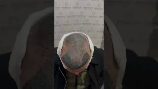 Hair Transplant Transformation 4000 Grafts [upl. by Arramas]