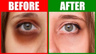 Can You Get Rid of Dark Circles Under Your Eyes Dermatologist Explains  Dr Sam Ellis [upl. by Harneen]