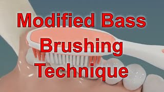 Tooth brushing Oral Hygiene Modifies Bass Method brushing technique [upl. by Lyrred]