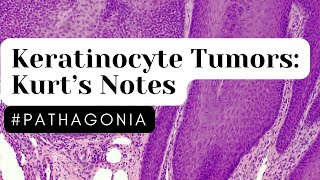 Keratinocyte Tumors Kurt’s Notes pathagonia [upl. by Rudman]